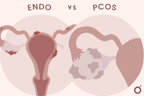 What’s the Difference Between PCOS and Endometriosis?